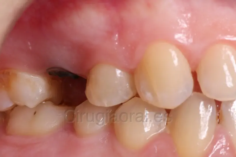 Foto intraoral de un molar con una caries grande y oscura que ha destruido la corona