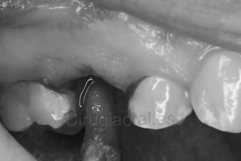 Foto intraoral en blanco y negro: la raíz saliendo del alvéolo sujeta por el instrumento, entre los dos dientes vecinos