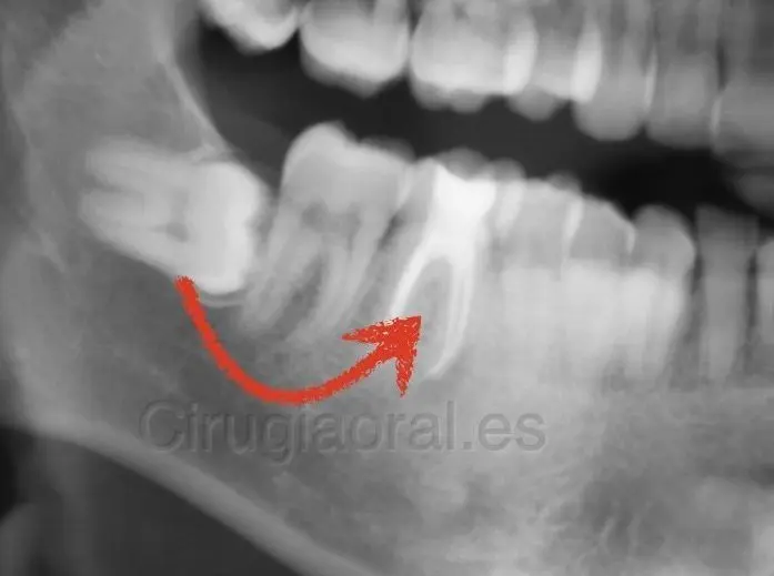 Radiografía de una muela del juicio inferior tumbada, con una flecha roja que señala al molar de delante