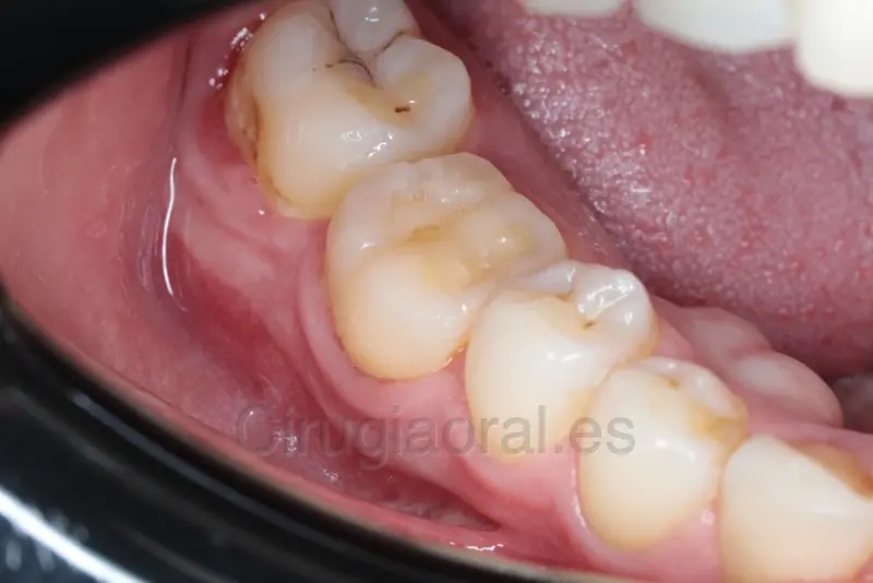 Foto intraoral del sector de abajo, con el molar trasplantado ya en función
