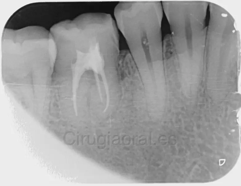Radiografía de los molares inferiores en el control, con el diente trasplantado en su sitio