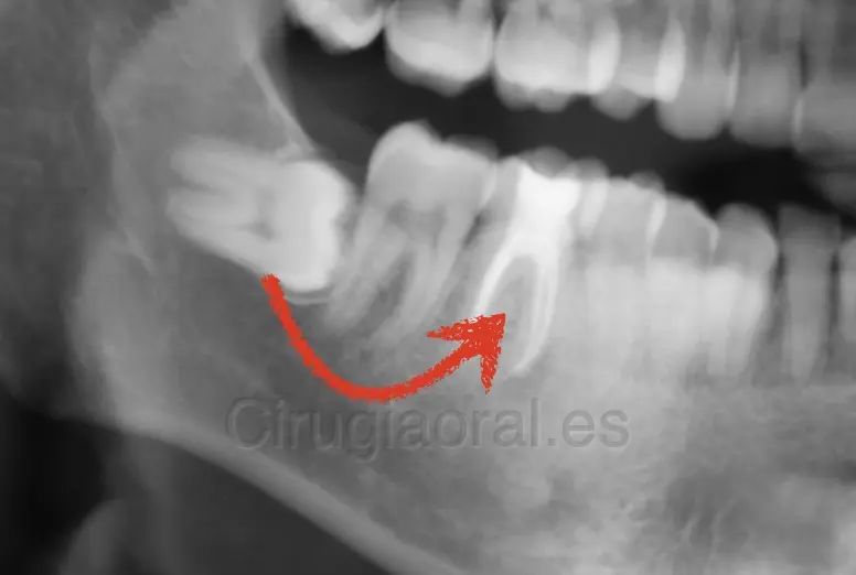 Radiografía con la muela del juicio inferior tumbada y una flecha roja hacia el hueco del primer molar